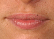 Vor der Anwendung - Lippen Pigmentierung